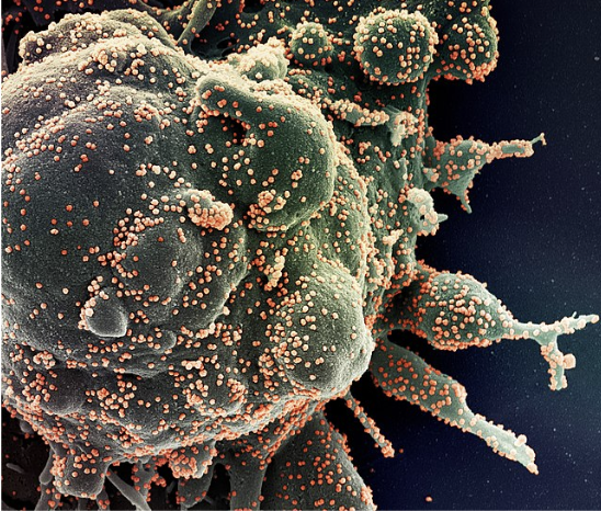 Picture of an isolated sample of patient cell (green structure) completely infected by COVID-19 particles (orange cells).

https://commons.wikimedia.org/w/index.php?search=covid&title=Special:MediaSearch&go=Go&type=image